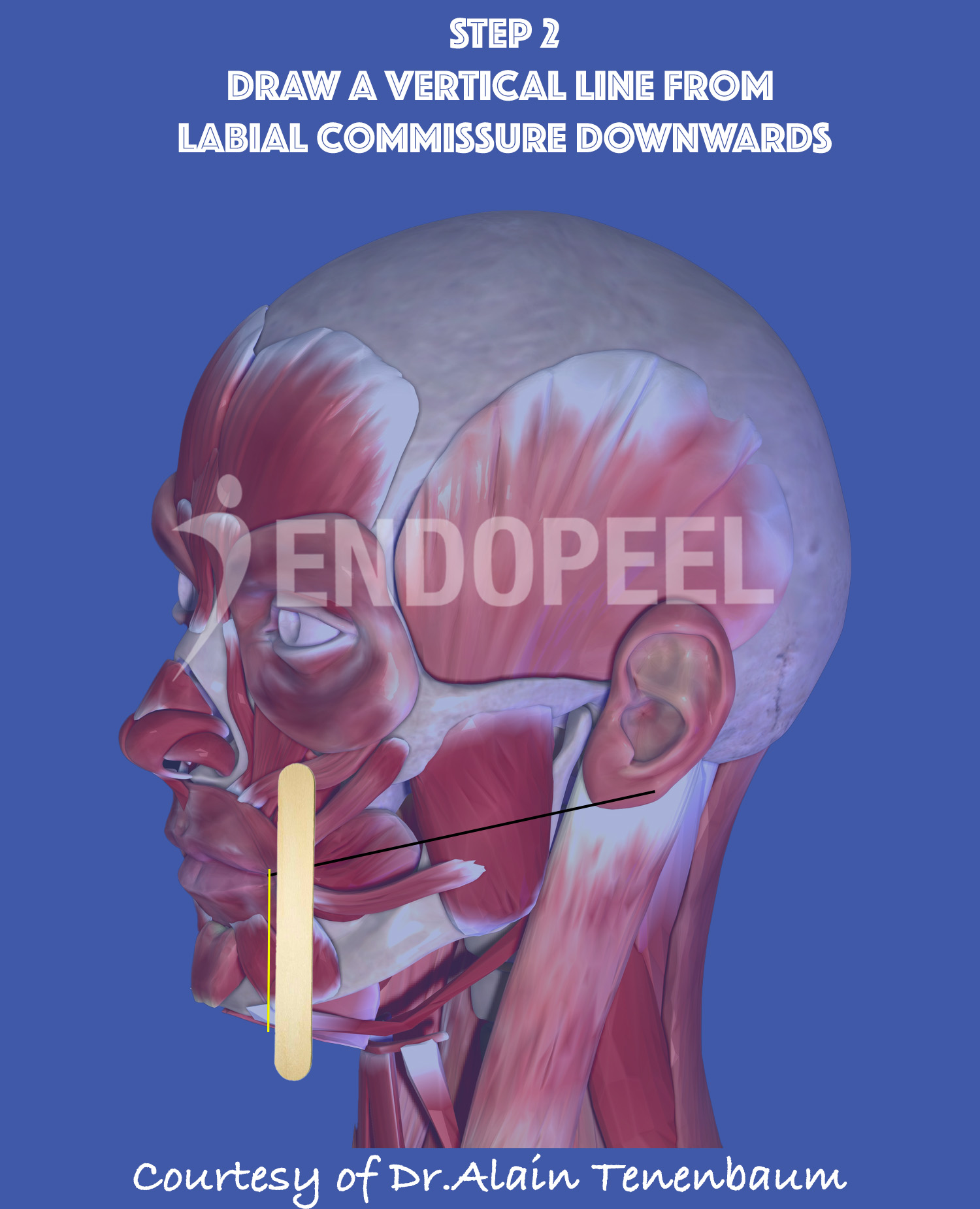 draw a line from labial commissure downwards