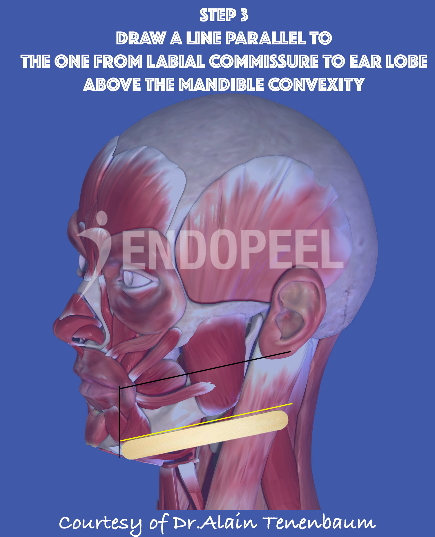 Step 3 : line above the mandible convexity parallel to the 1 st line