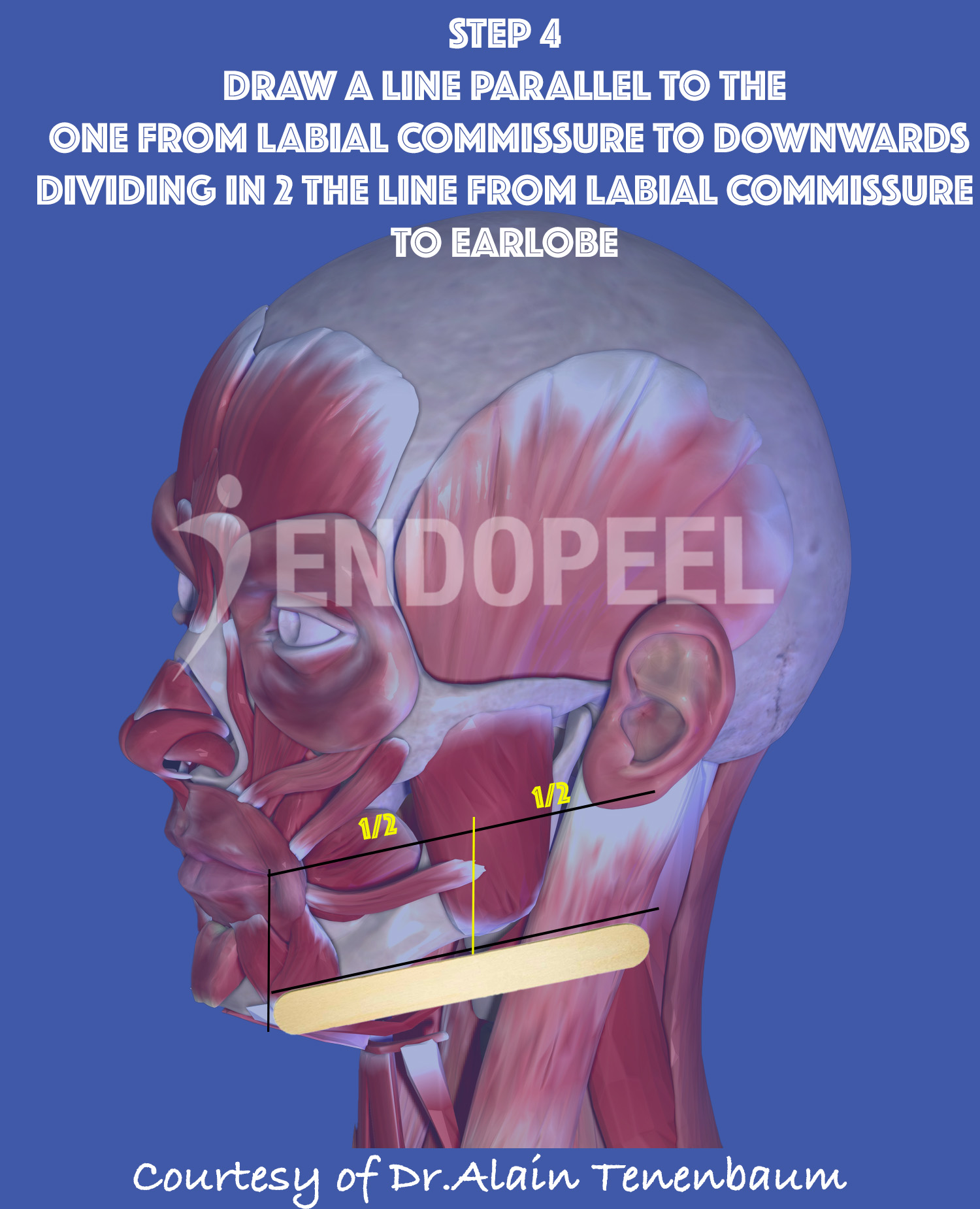 divide in 2 the line from labial commissure to ear lobe with a vertical