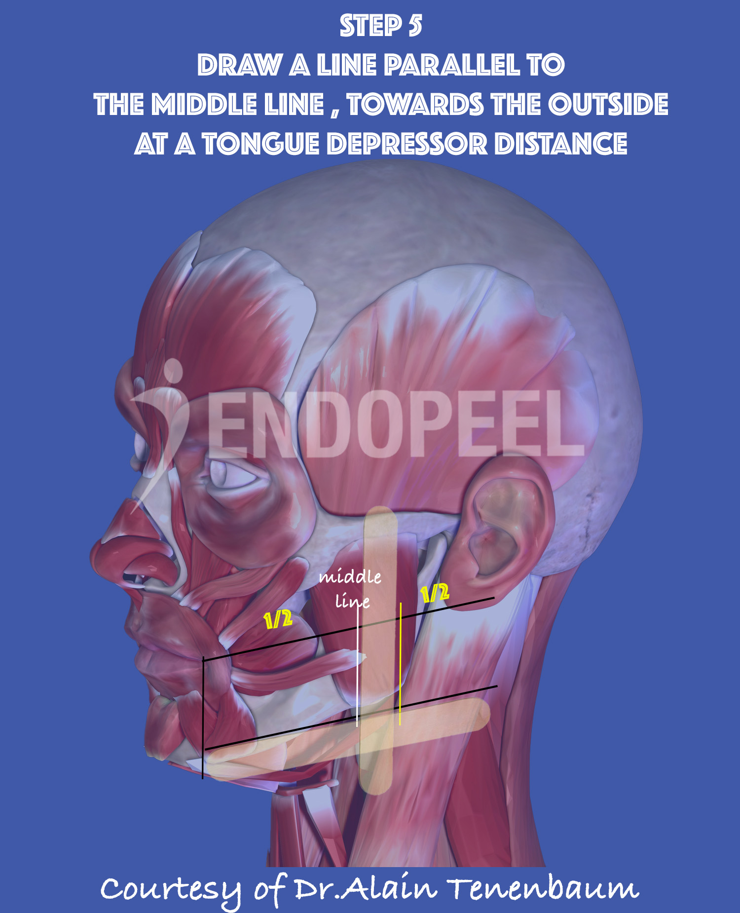 1 tongue depressor towards outside from the middle line