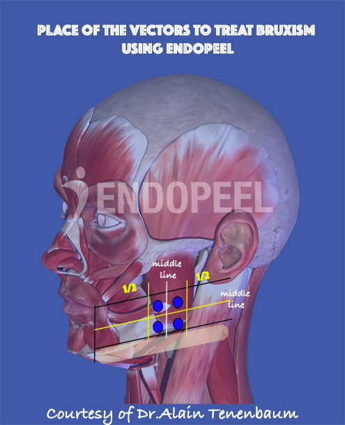 vectors-endopeel-bruxism