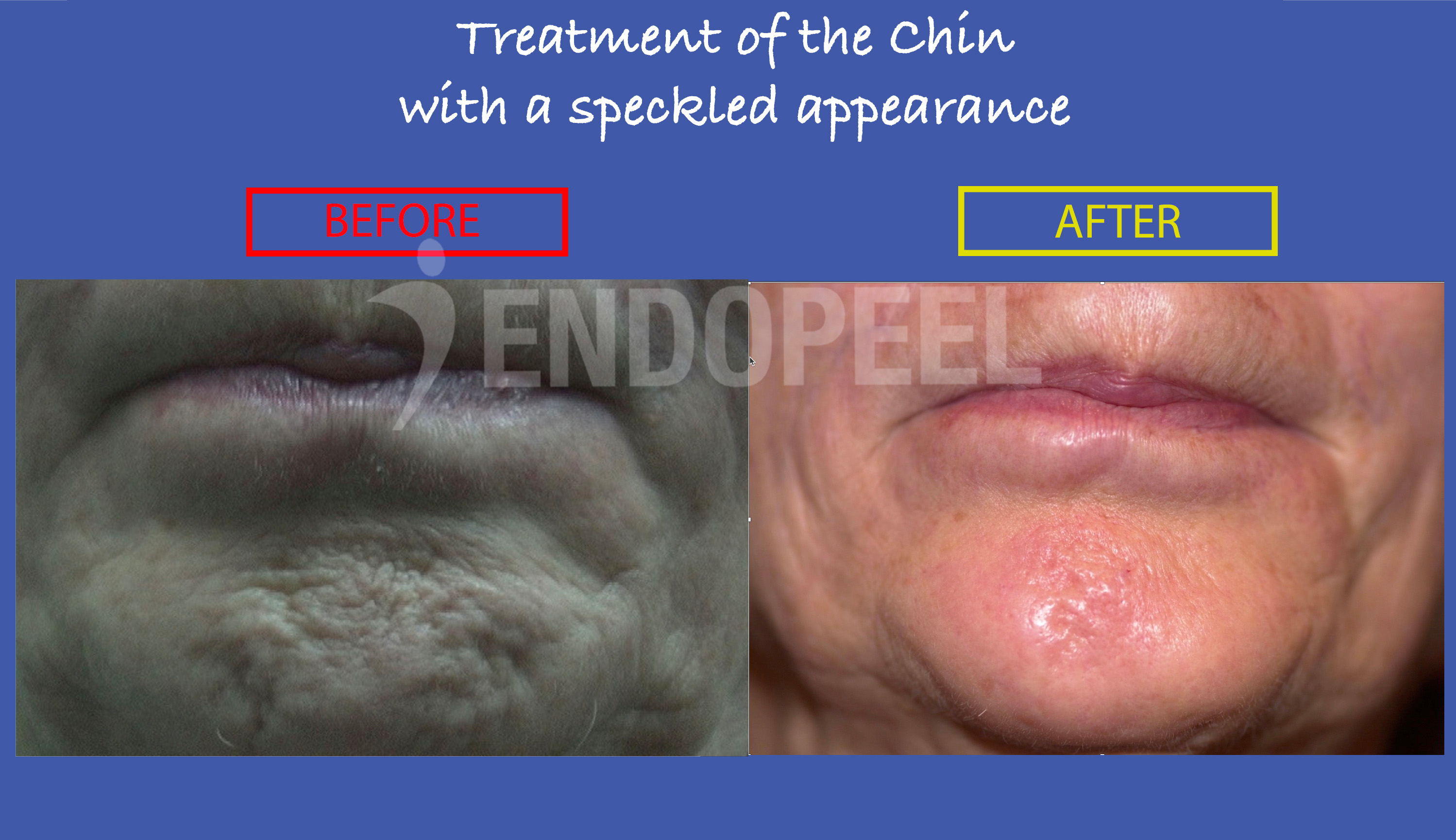 speckled-chin-result