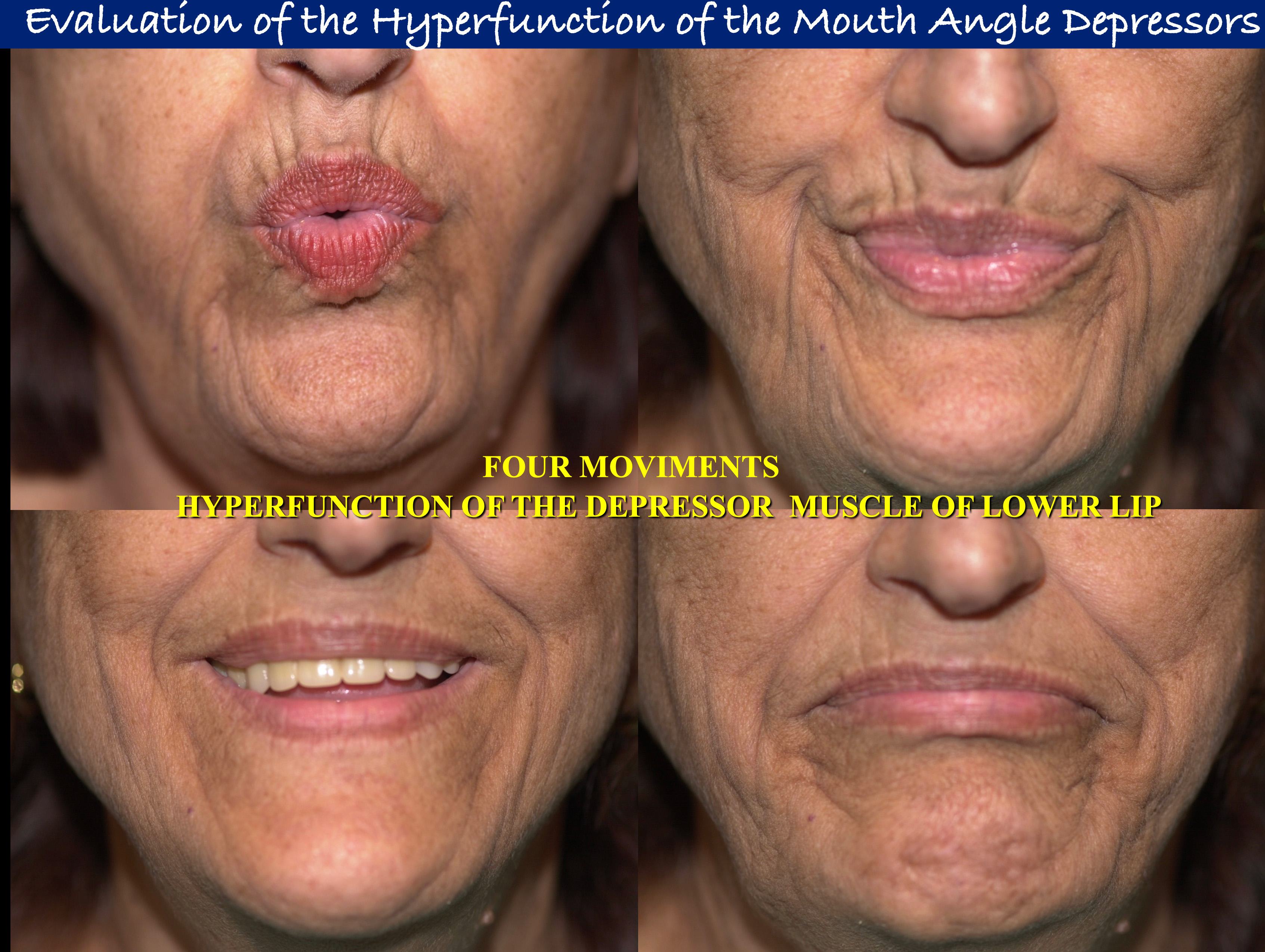 evaluation-mouth-angle-1