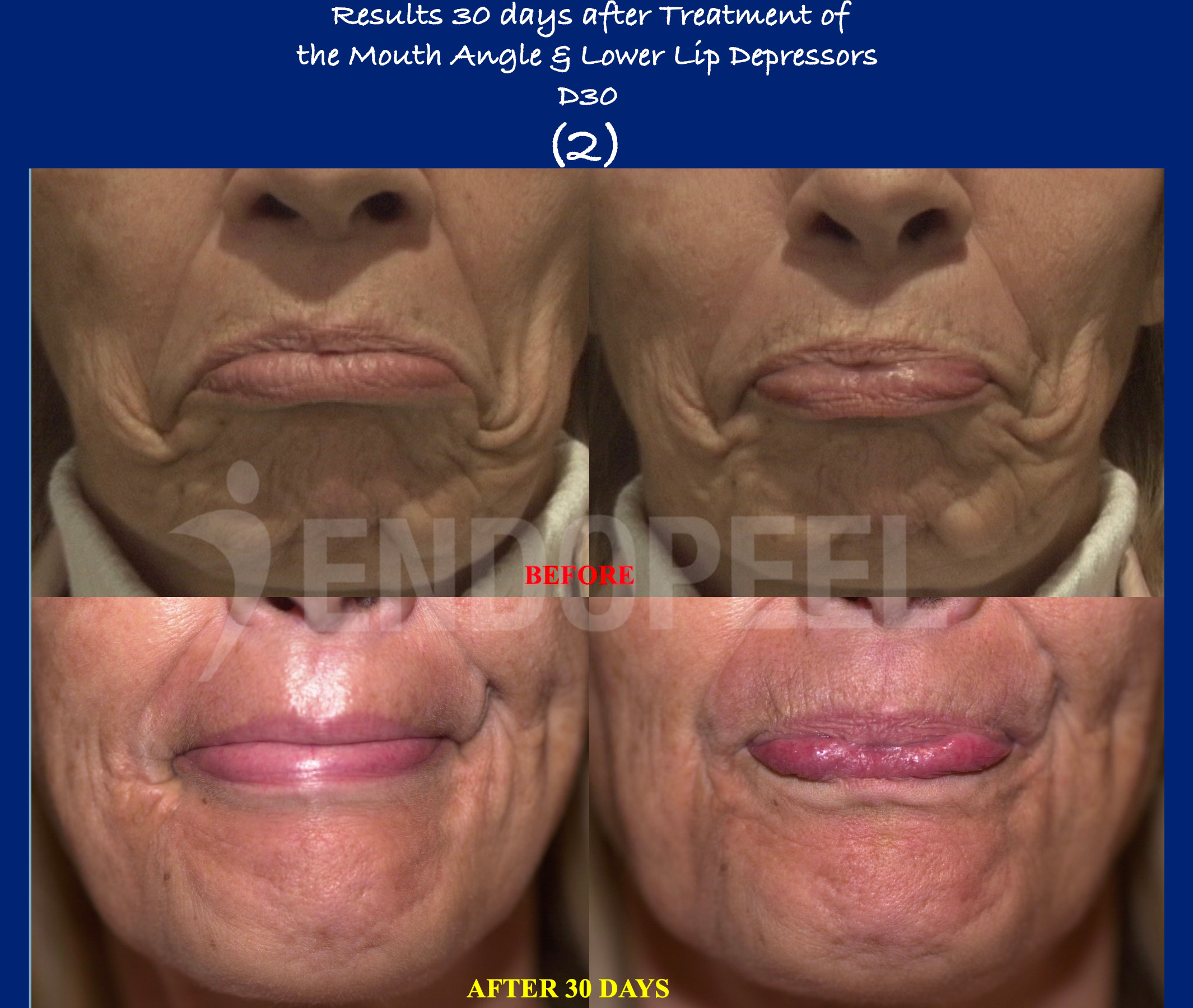 lower-lip-depressors-D30-2