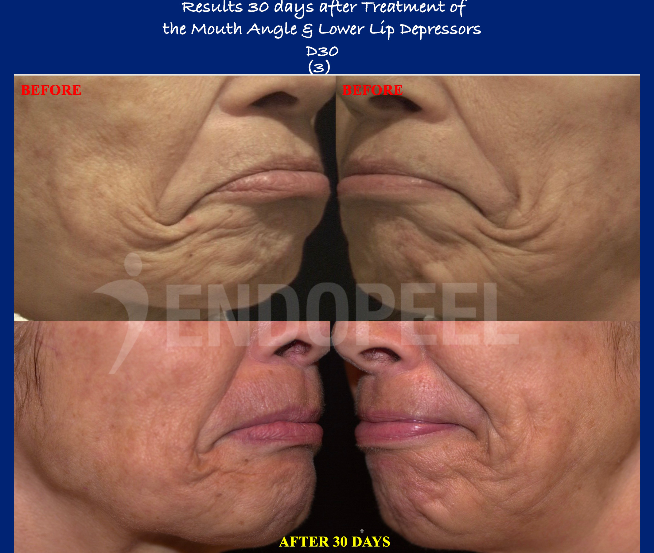 lower-lip-depressors-D30-3