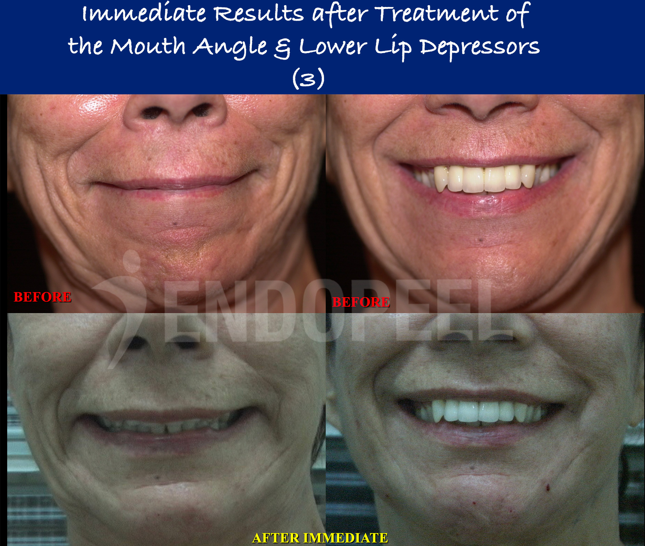 lower-lip-depressors-results-3