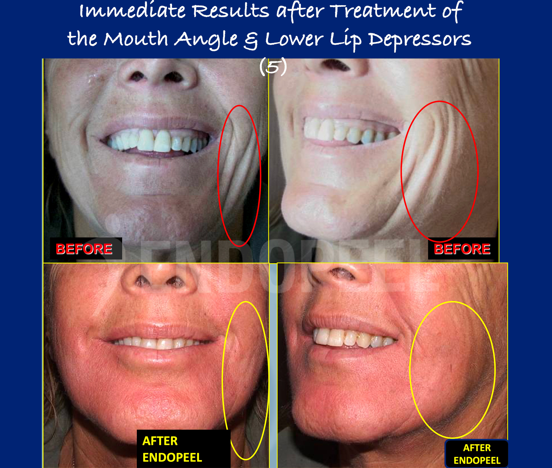 lower-lip-depressors-results-5