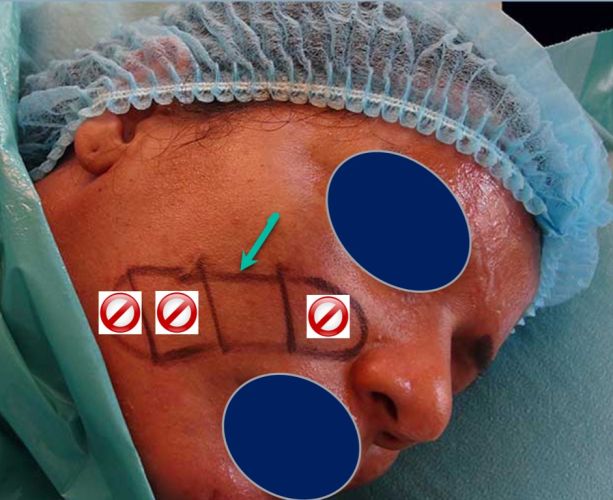 Just treat this middle square