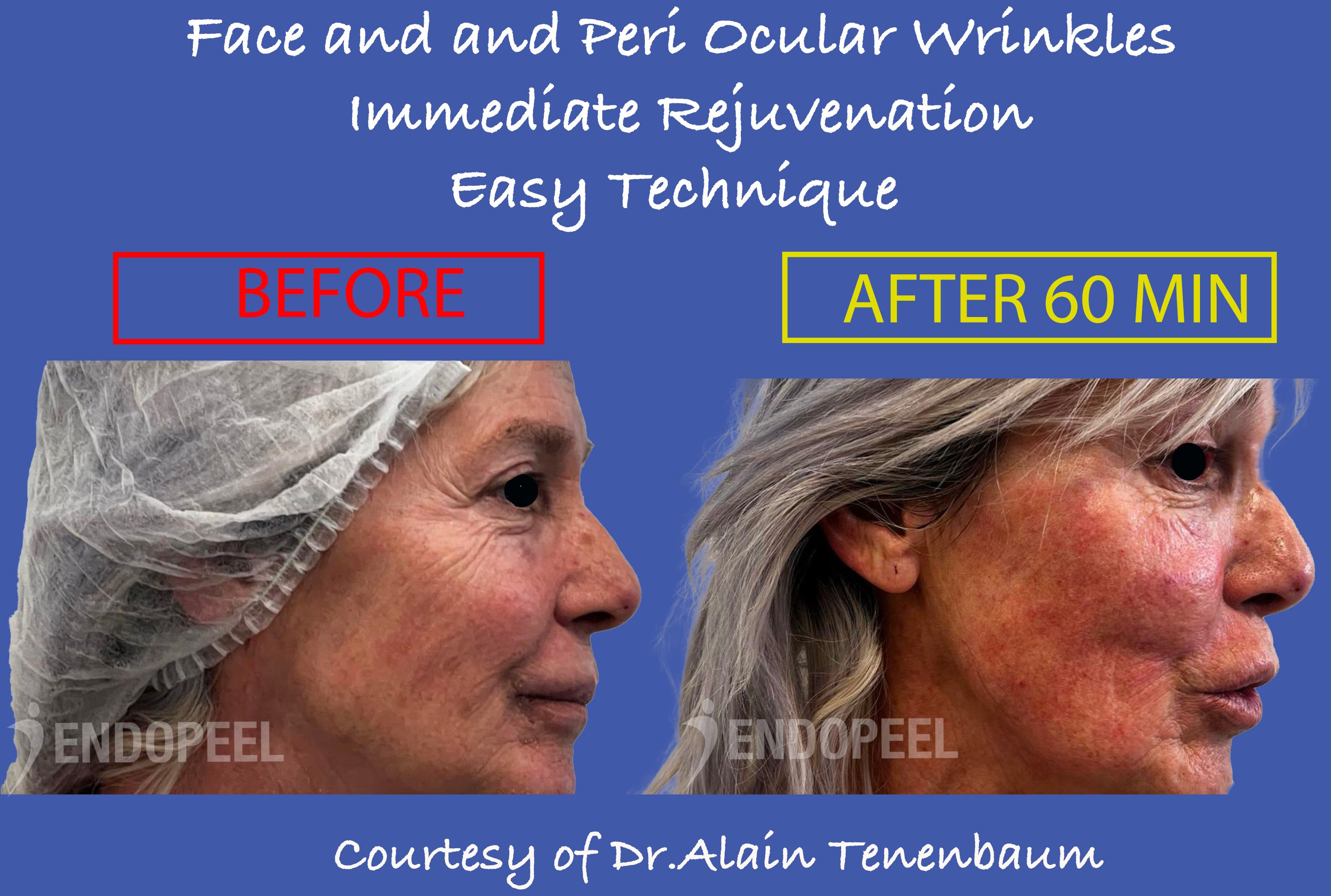 periocular-wrinkles-endopeel