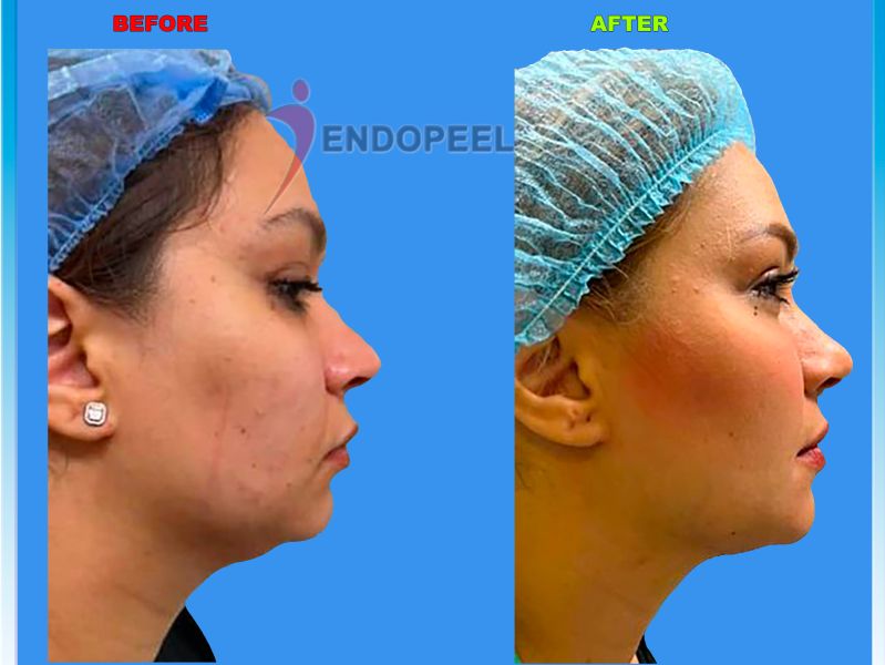 north african female right profile neck ENDOPEEL treated