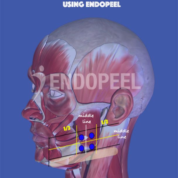 vectors-endopeel-bruxism