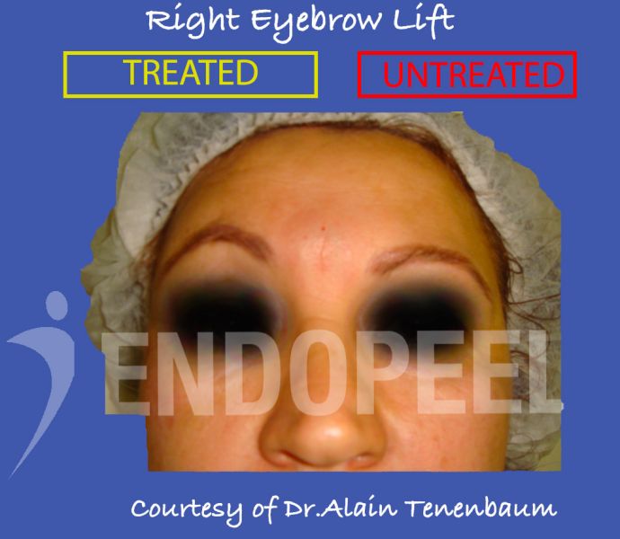 right-eyebrow-lift-endopeel