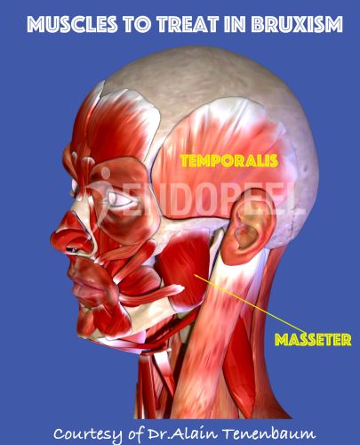 target muscles in bruxism