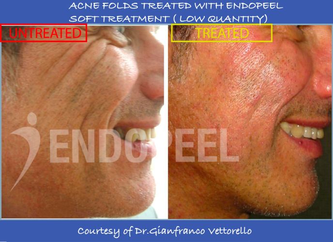 acne-scars-soft-endopeel-gf