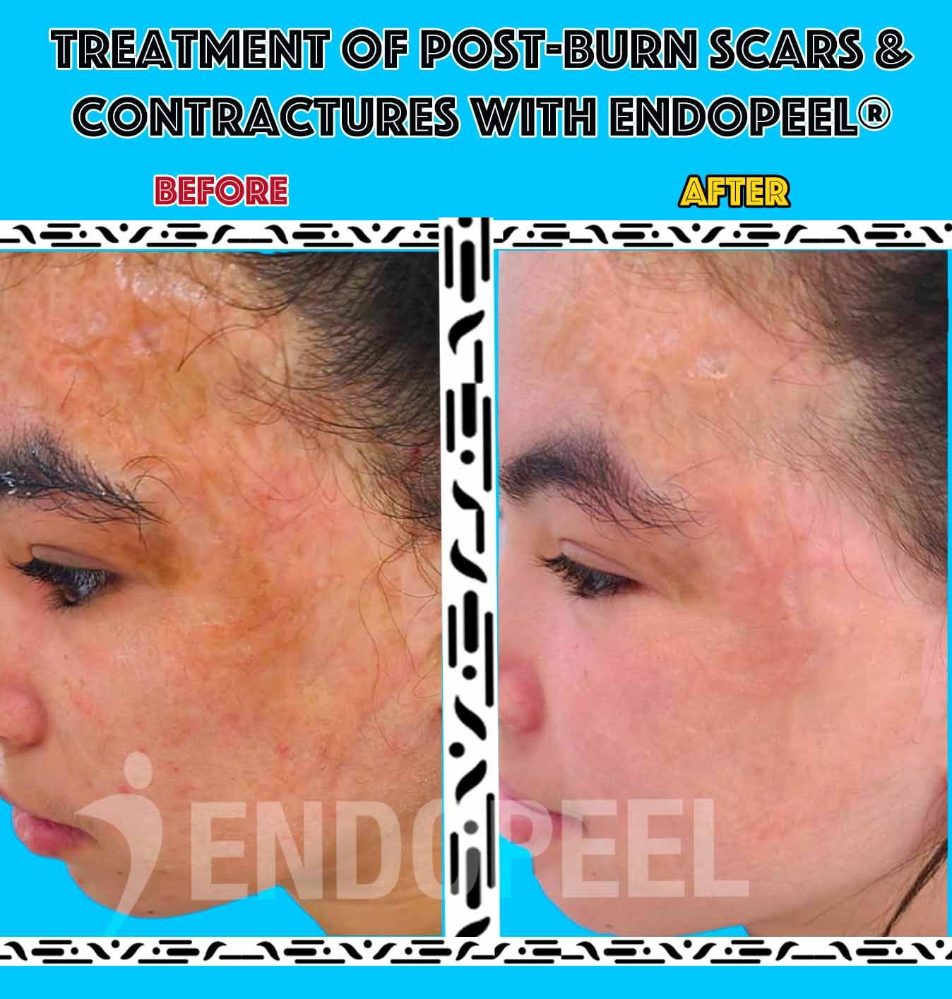 facial sequellae of burns treated with endopeel and peeling de luxe