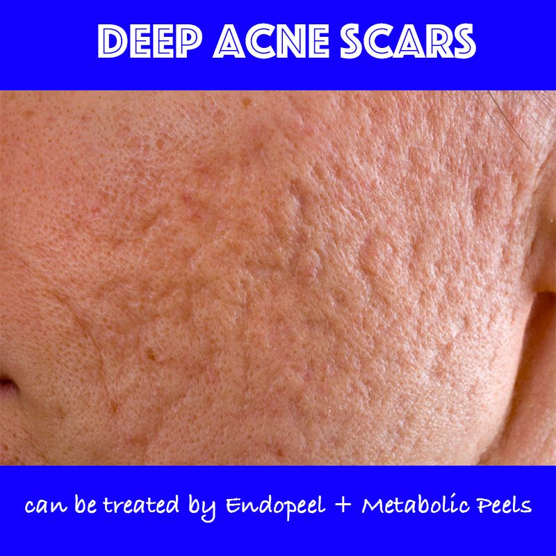 Acne Scars