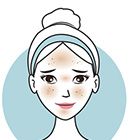 hyperpigmentation-lower-eyelid