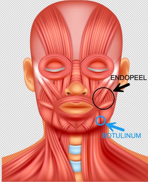 combination-endopeel-botulinum-injections