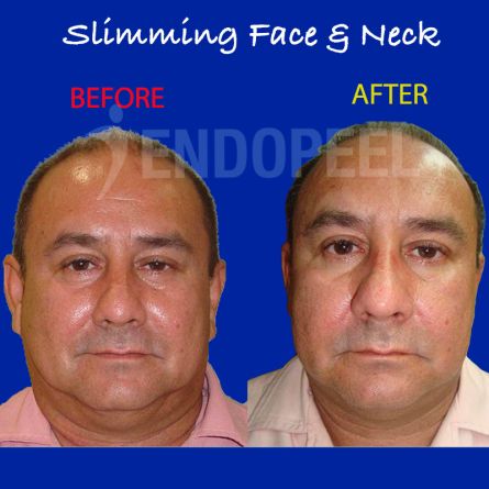 chubby-face-slimming