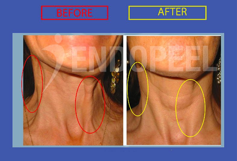 platysma-treatment-endopeel