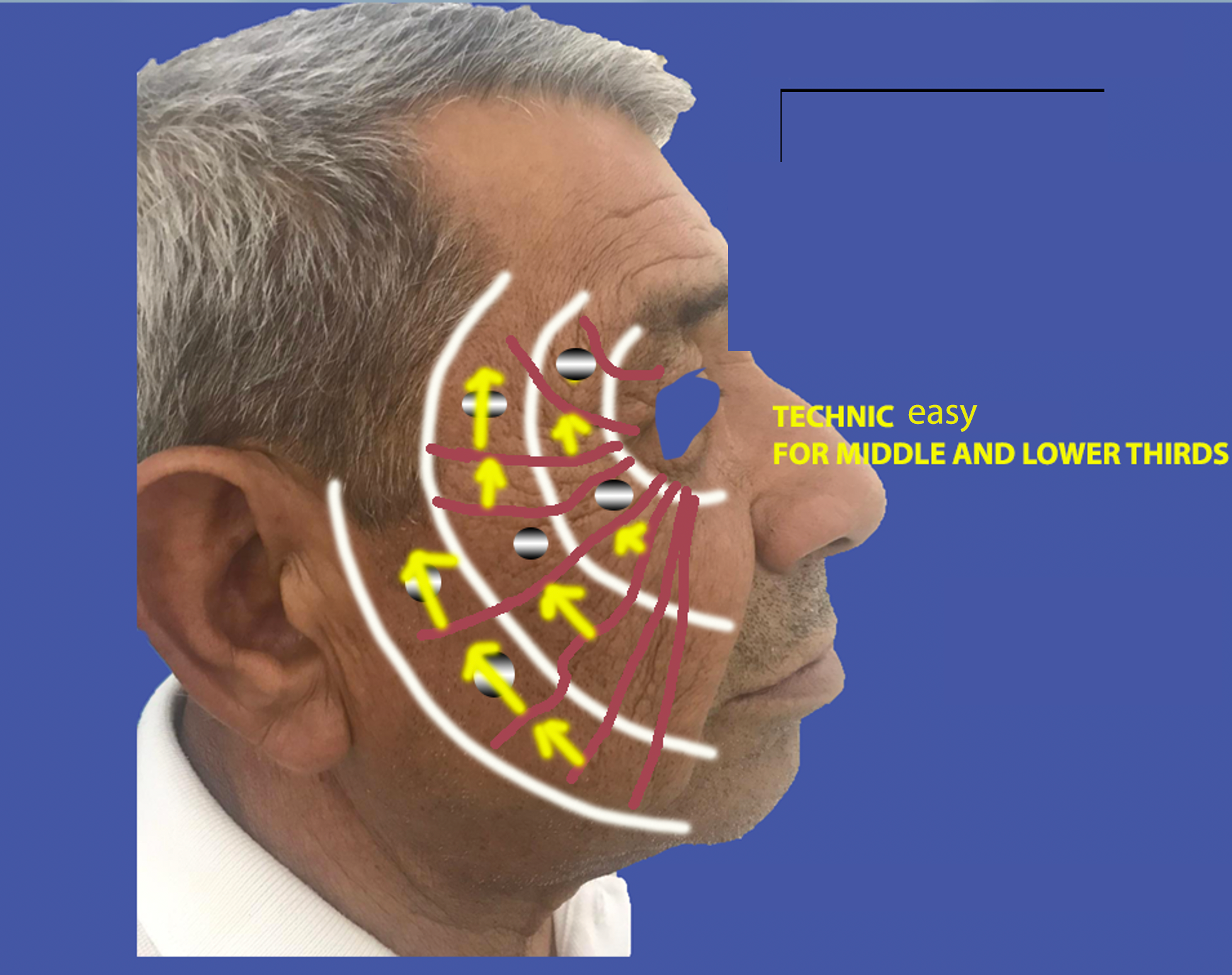 easy technic endopeel face