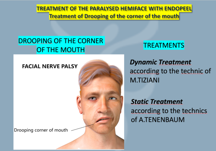 resume of treatment for drooping of the corner of the mouth