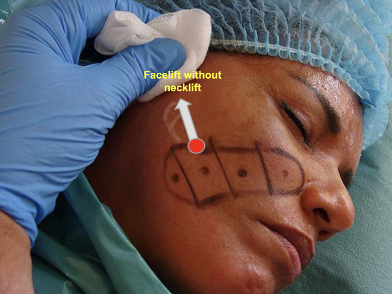 facelift without neck lift medium third lower tensor