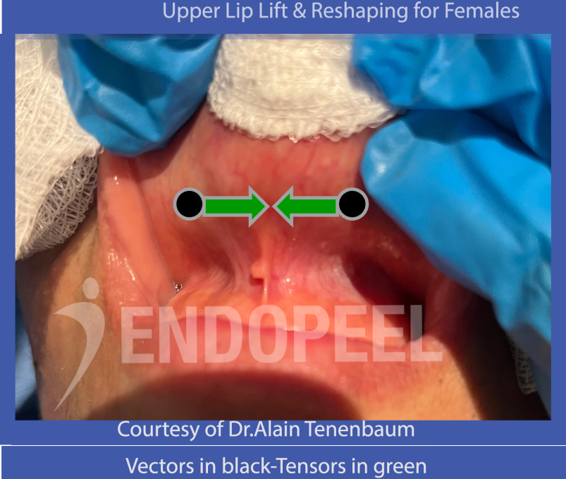 female upper lip lift and reshaping