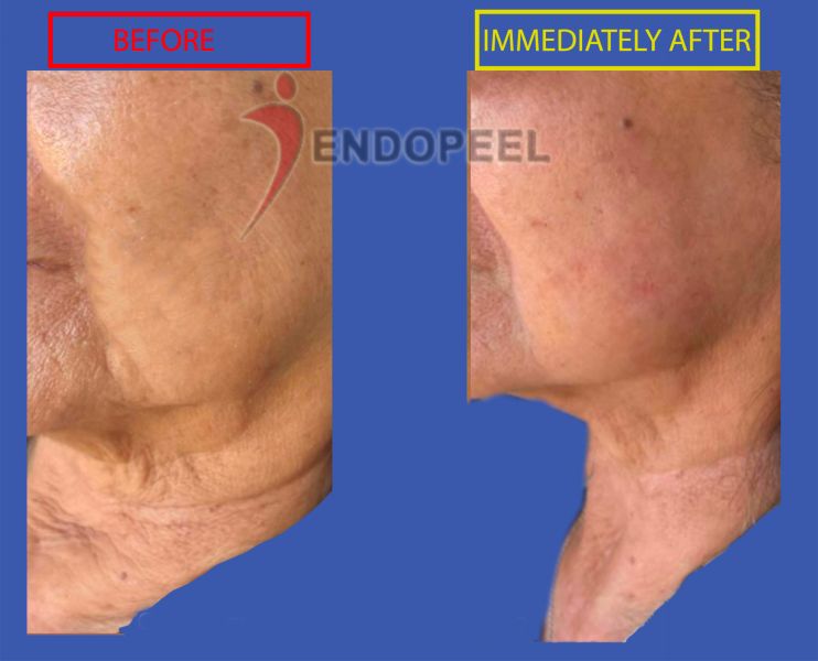 neck-lift-endopeel