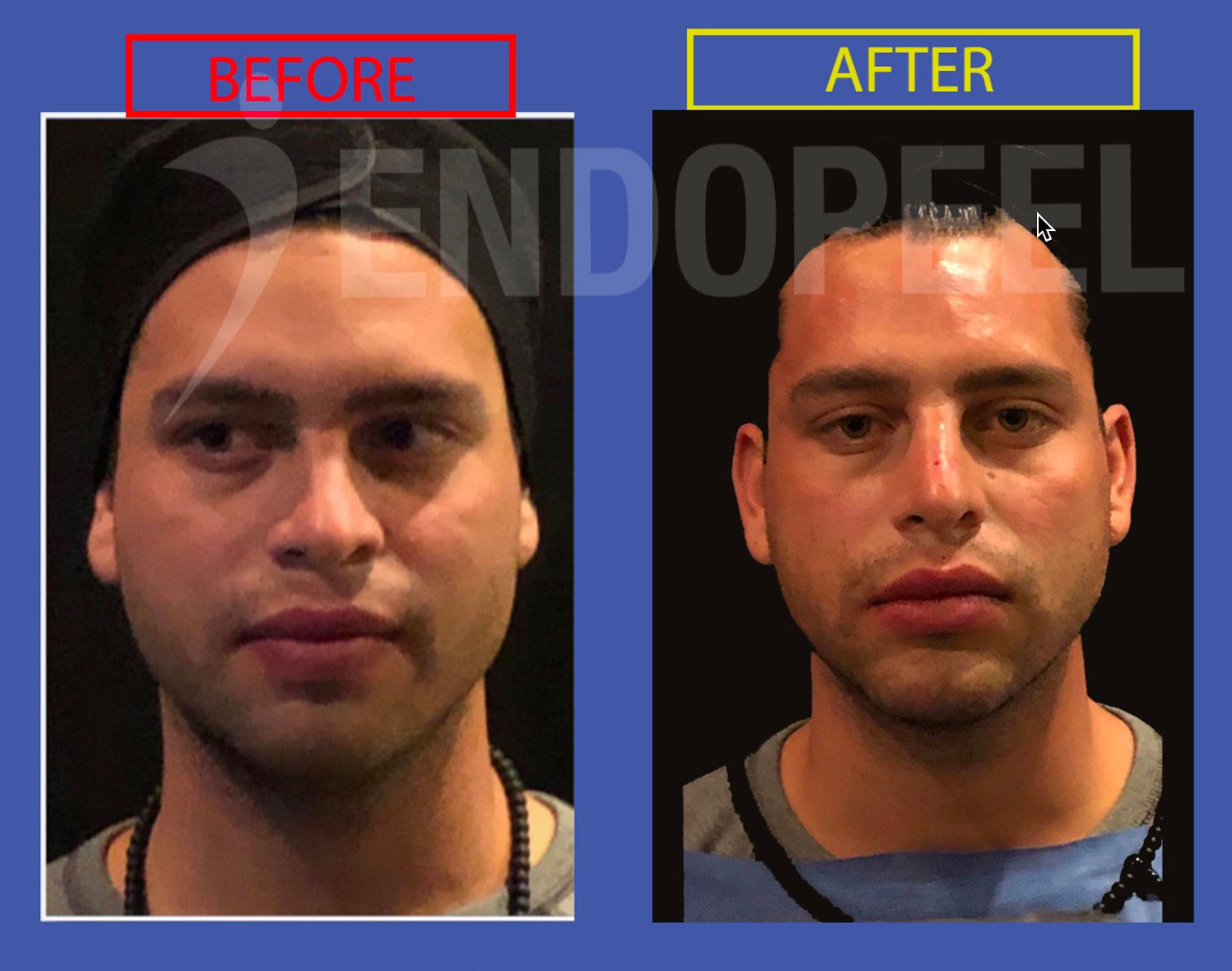 face-masculinization-endopeel