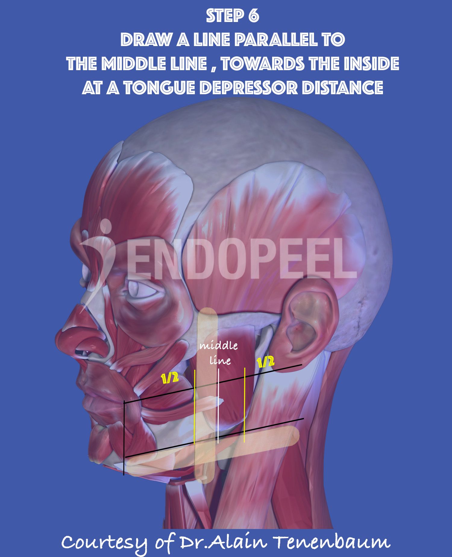 1 tongue depressor towards inside  from  the middle line