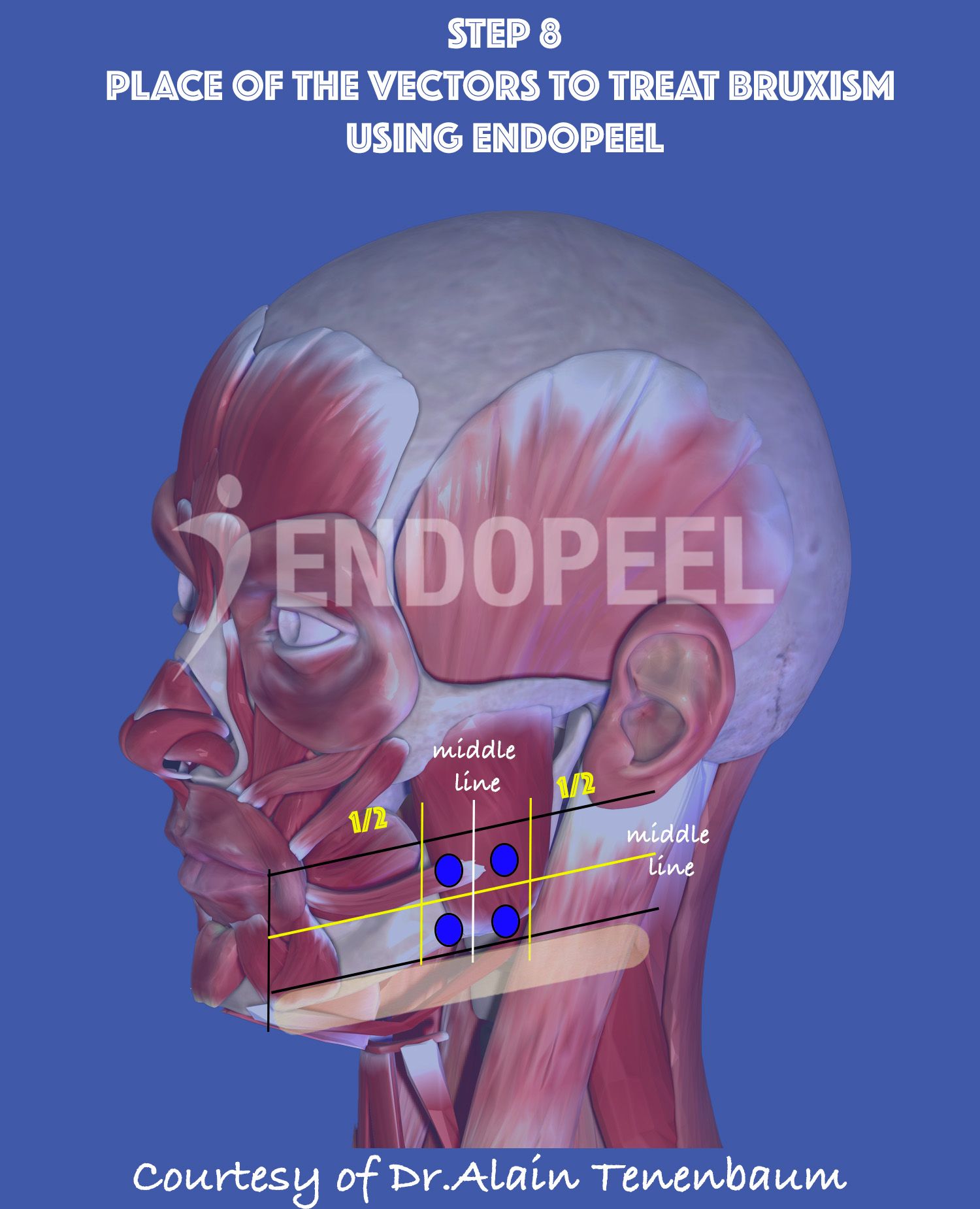 Endopeel Vectors and  Bruxism 