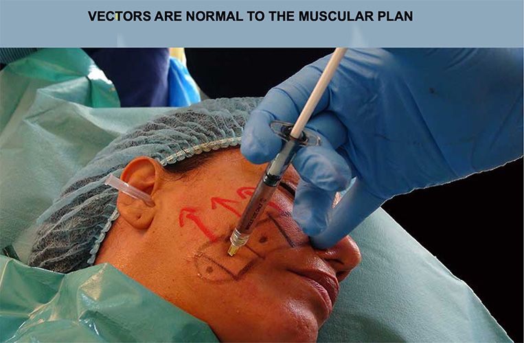 1 st lower square vector injection