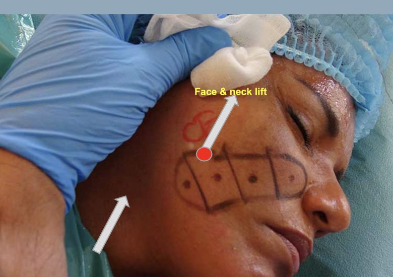 face & neck lift lower tensor