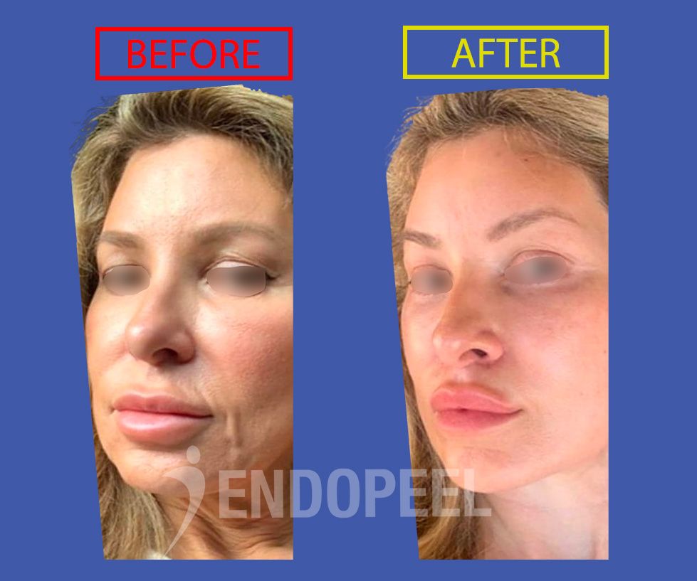 urkish-facelift-40y-female