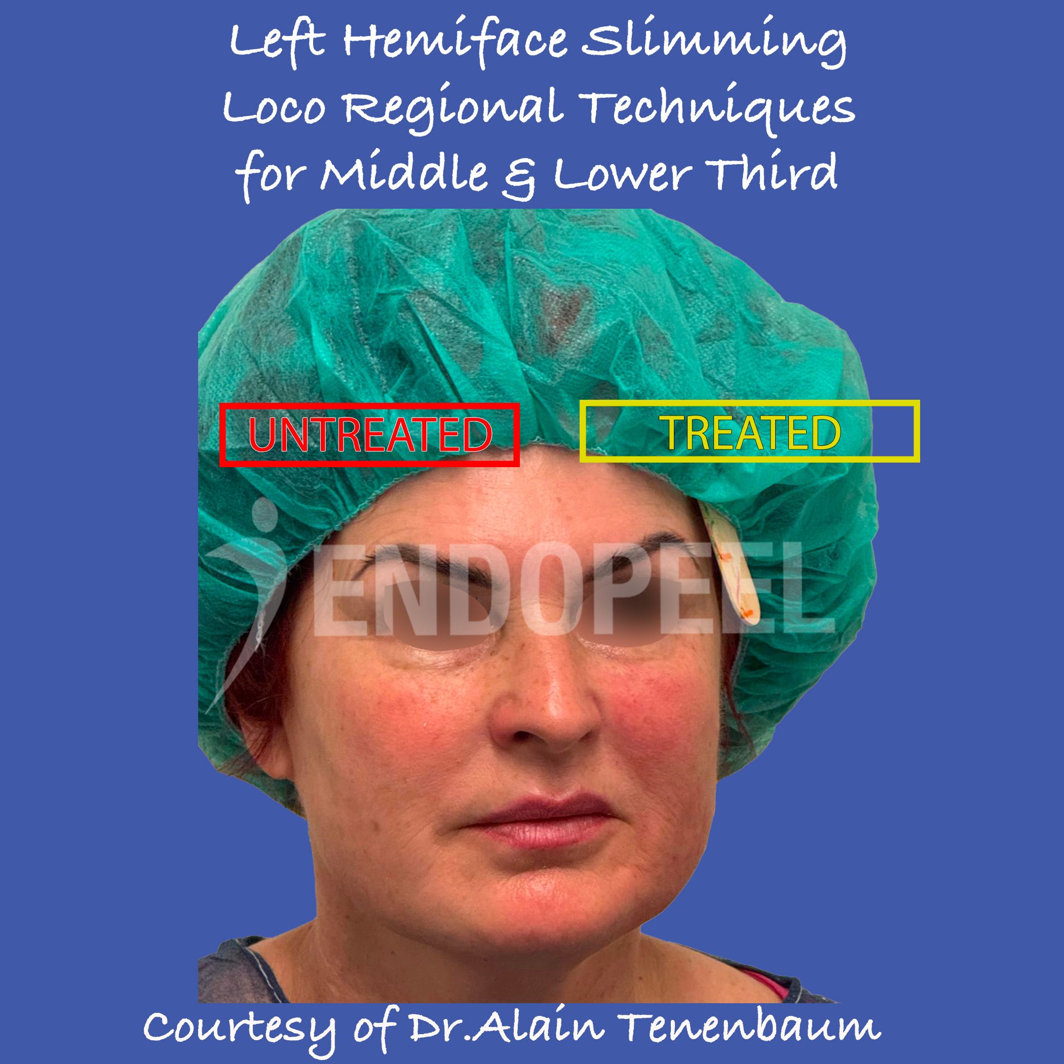 left-hemiface-slimming