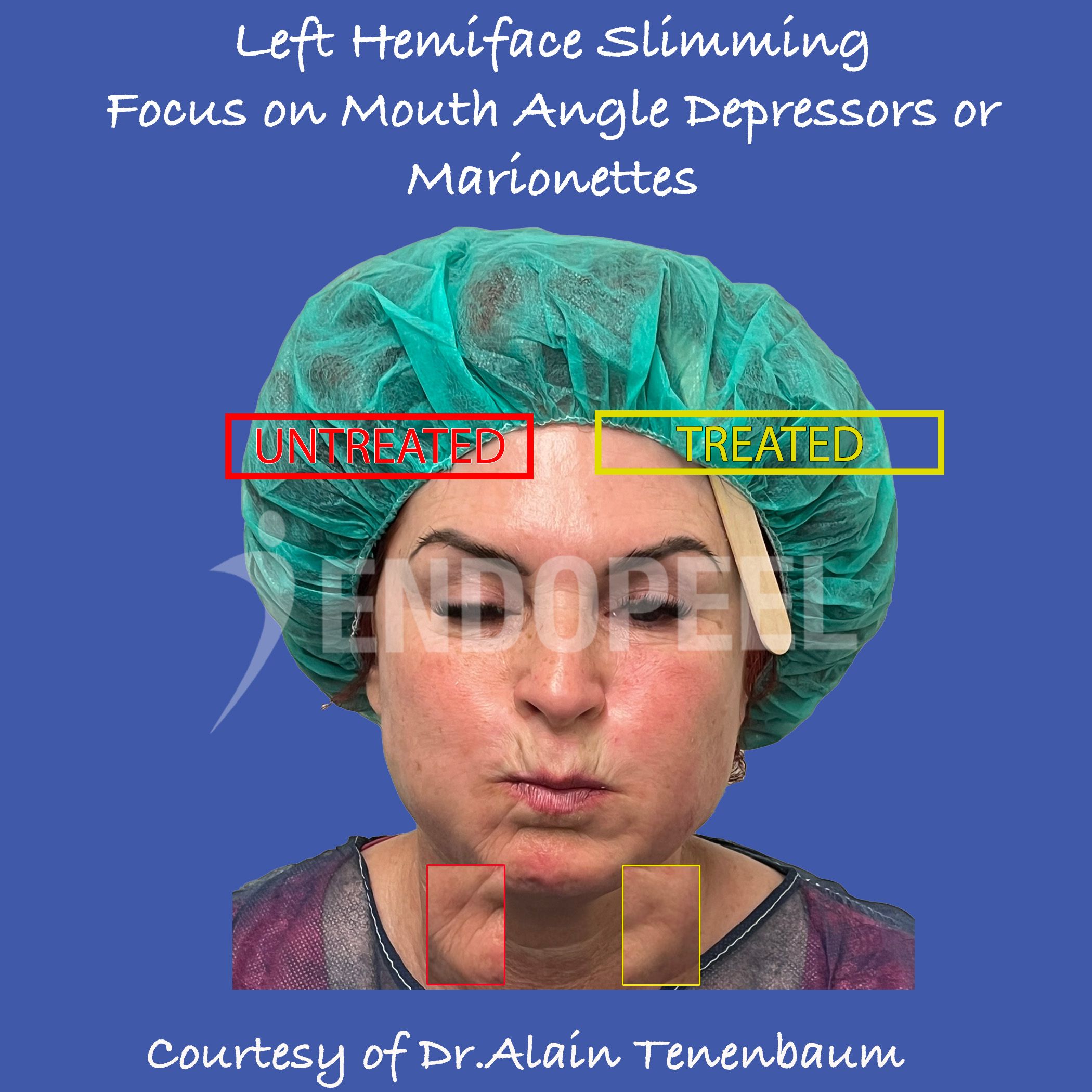 Marionette or Lower Lip Depressors Unaestheticisms