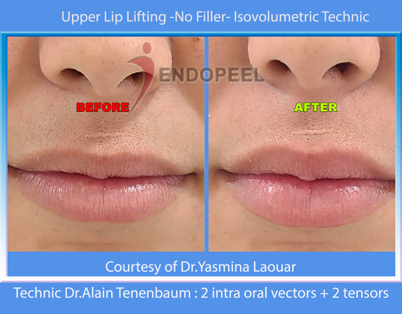 upper Lip lifting-Technic Tenenbaum