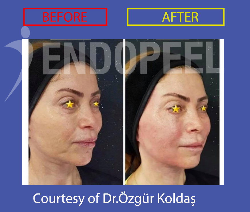 facial tightening 2 and endopeel 