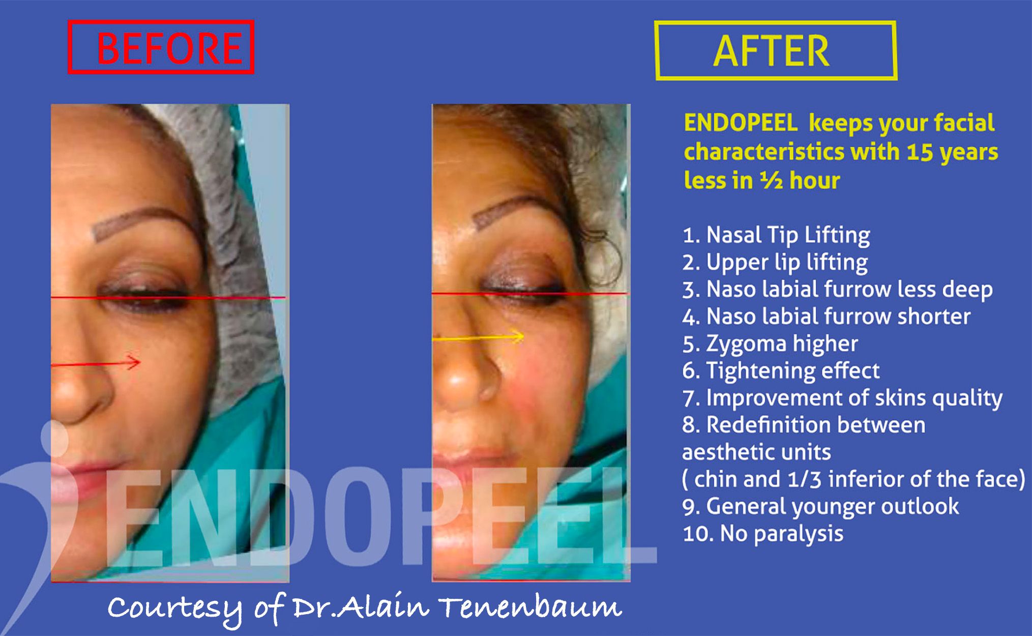 10-signs-facecontour-endopeel