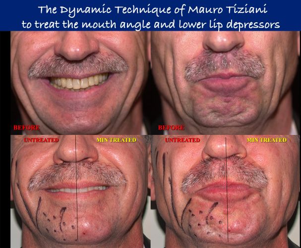 dynamic-technic-tiziani-lower-third-depressors