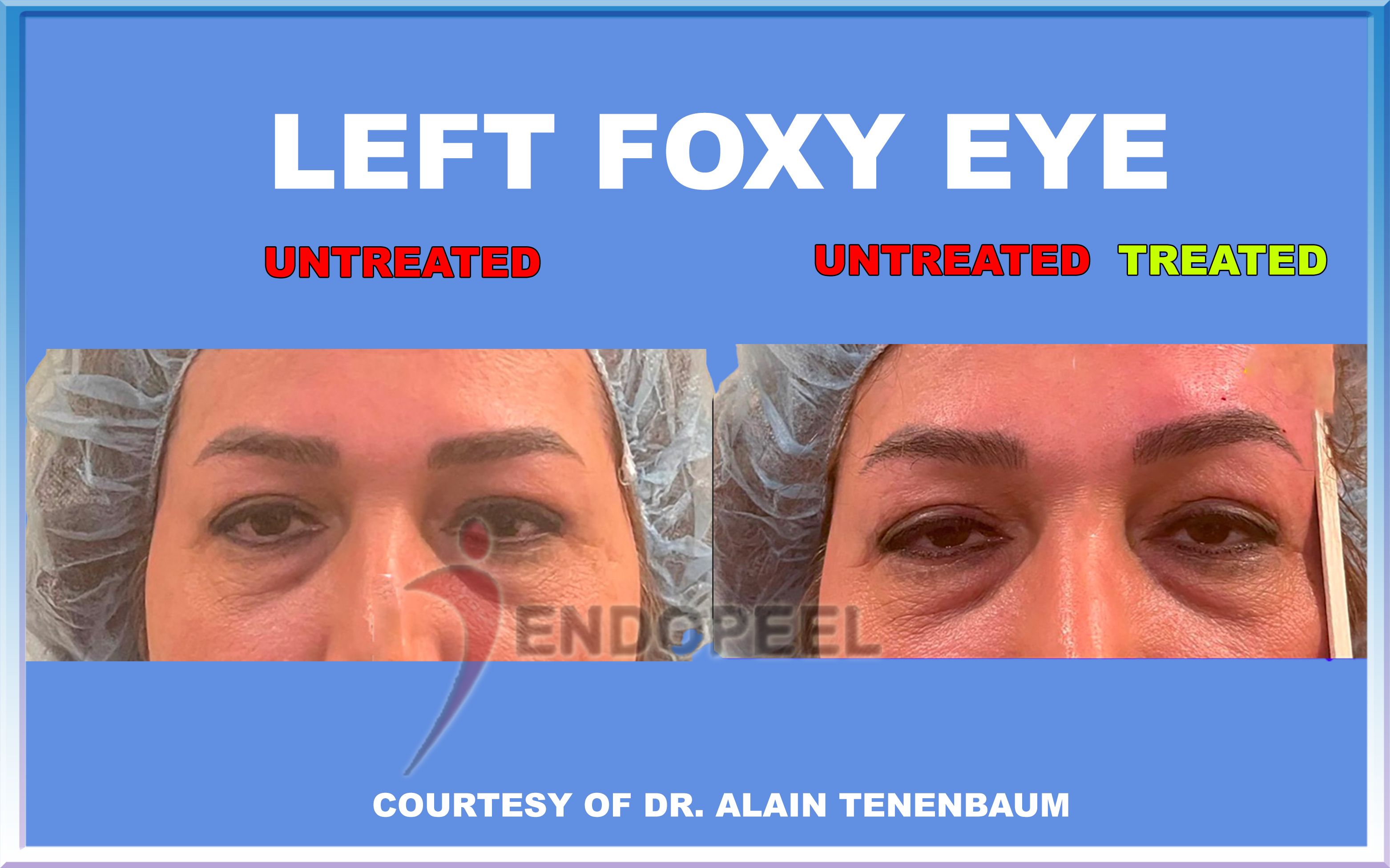 left-foxy-eye-endopeel-tenenbaum