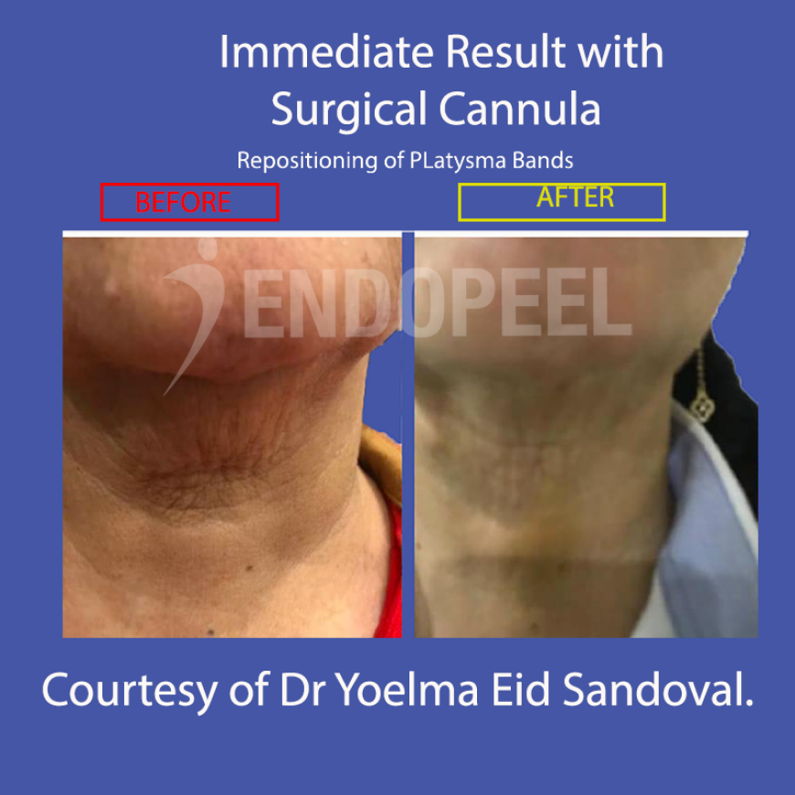 Immediate Result of Platysma Bands Repositioning using Cannula and Endopeel