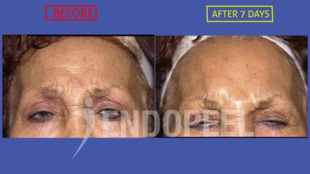 female forehead wrinkles eyes down endopeel