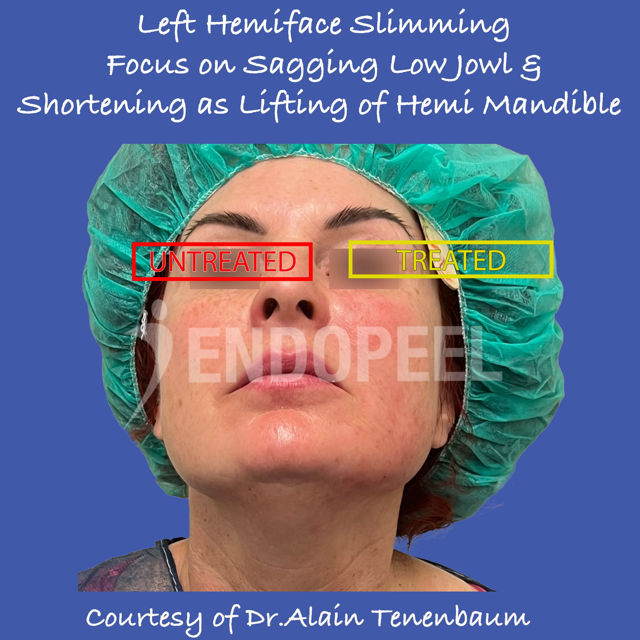 Slimming Face & Mandible Shortening and Lifting