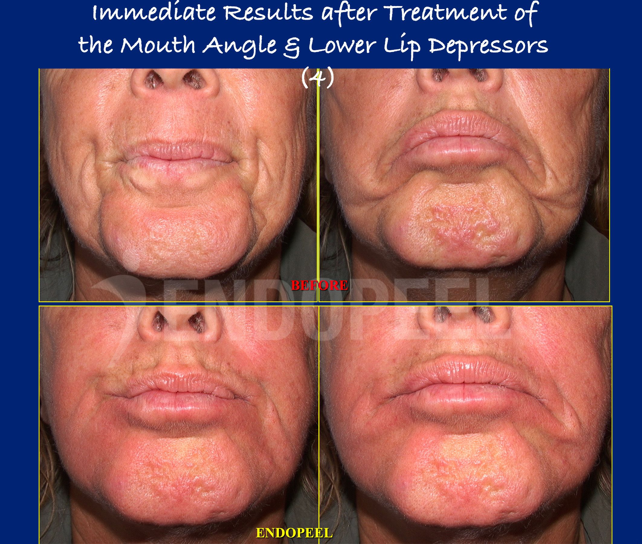 lower-lip-depressors-results-4