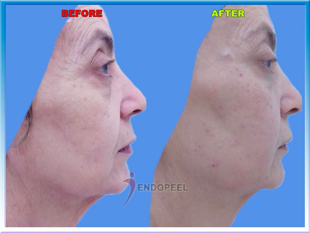Periocular Wrinkles treated by Dr.Amina Mebarki