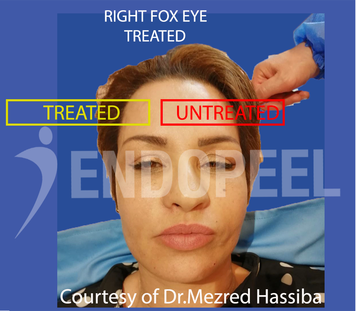 fox-eye-endopeel-hassiba