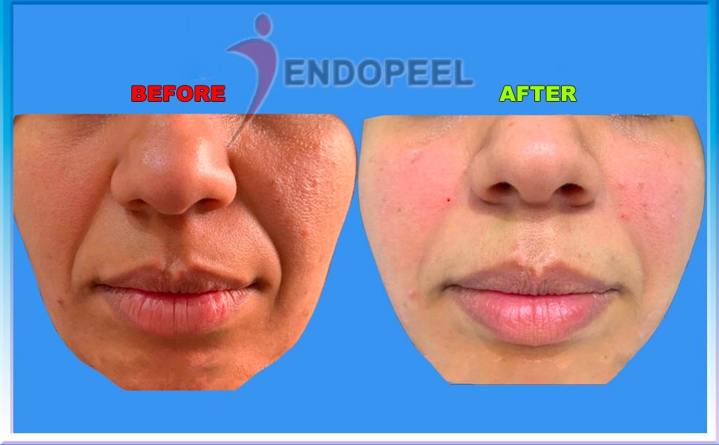 medium-third-endopeel