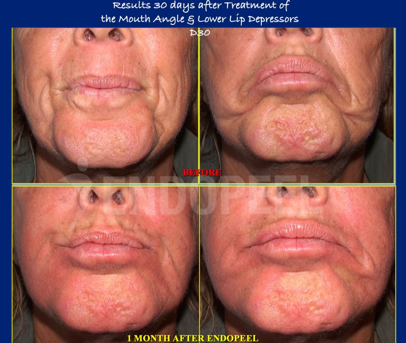 lower-lip-depressors-results-D30